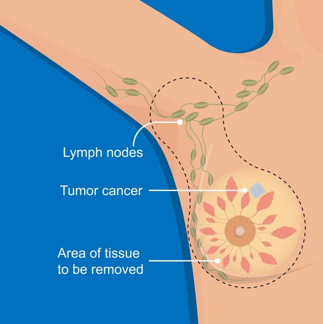 Buyer Beware My Mastectomy Flat Closure Nightmare Tissue Removal